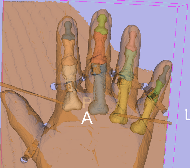 EMS Result 3DReconstruction CT-Hand-Bone.png