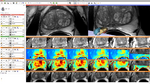 Prostate multiparametric visualization Slicer4.png