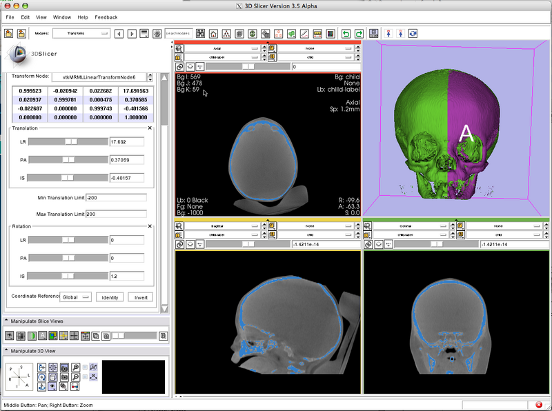 File:Xoran-Cone-beam-CT Craniofacial Asymetry-2009-08-27.png