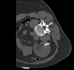this is the fixed CT reference image. All images are aligned into this space
