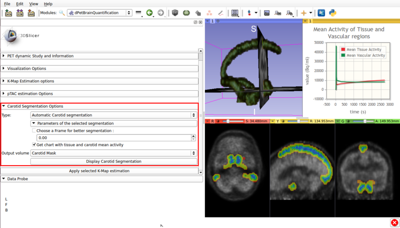 Figure 4. Screencap of the Carotid segmentation options panel. The automatically segmented vascular regions are displayed on the viewer window.