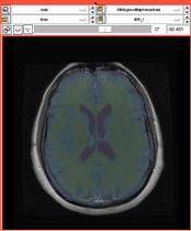 EMSegmentRev PETCT B.png