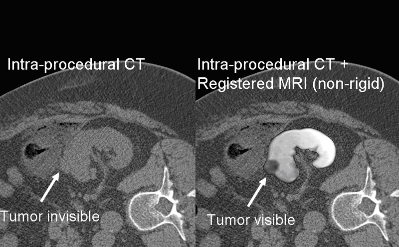 File:Deformable registration Screenshot1.png