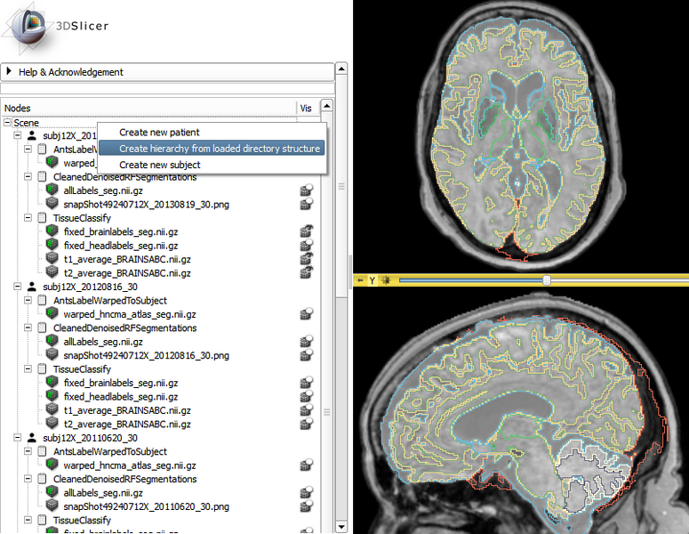 File:SlicerRT 0.13 HuntingtonsLongitudinalInSubjectHierarchy2.png