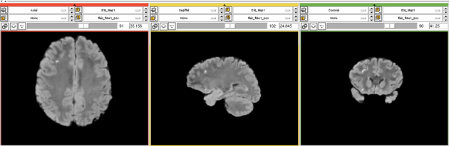 EMS LesionExp FLAIR.png