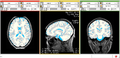 EMS PED MS Study Segmentation.png