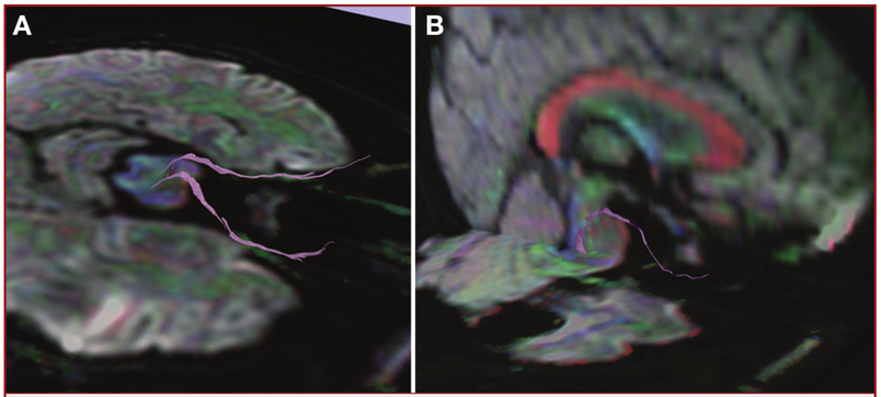 File:Hodaie-Neurosurgery2010-fig6.png