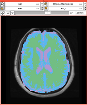EMSegmentRev PETCT C.png