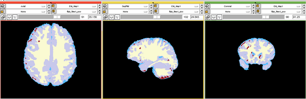 EMS LesionExp Segmentation.png