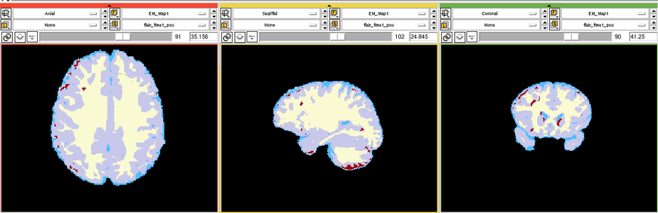 EMS LesionExp Segmentation.png