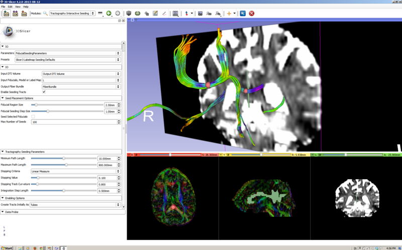 File:Tractography Fiducial Seeding.PNG