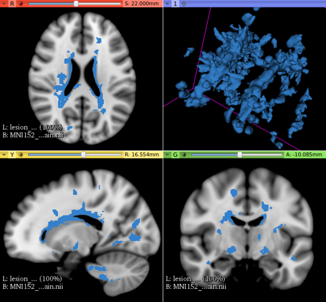 File:LesionLoad 40mL.png