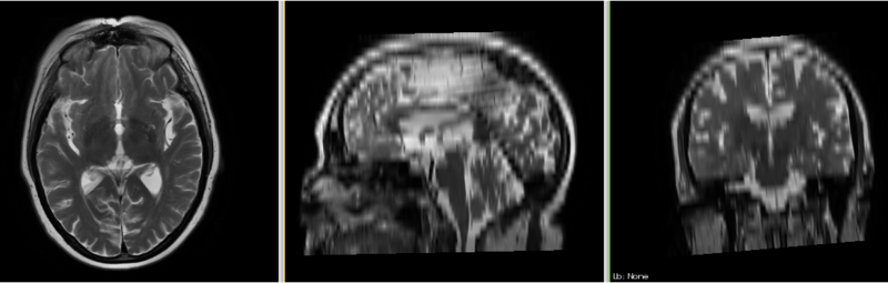 File:MRI-Human-Brain-HIPR-T2FSE.png