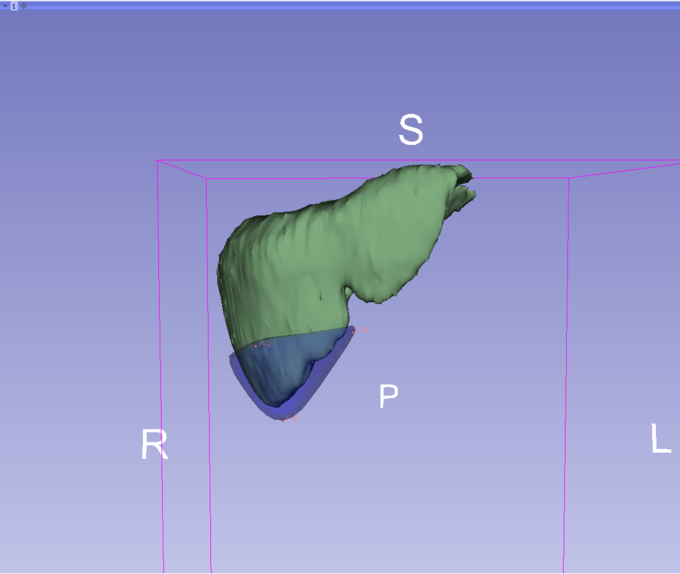Documentation/Nightly/Modules/ResectionVolume - Slicer Wiki
