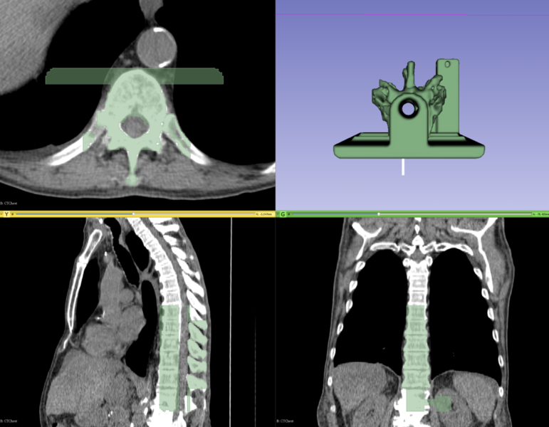 File:SlicerWinterProjectWeek2017-Segmentation-for-3d-printing.png